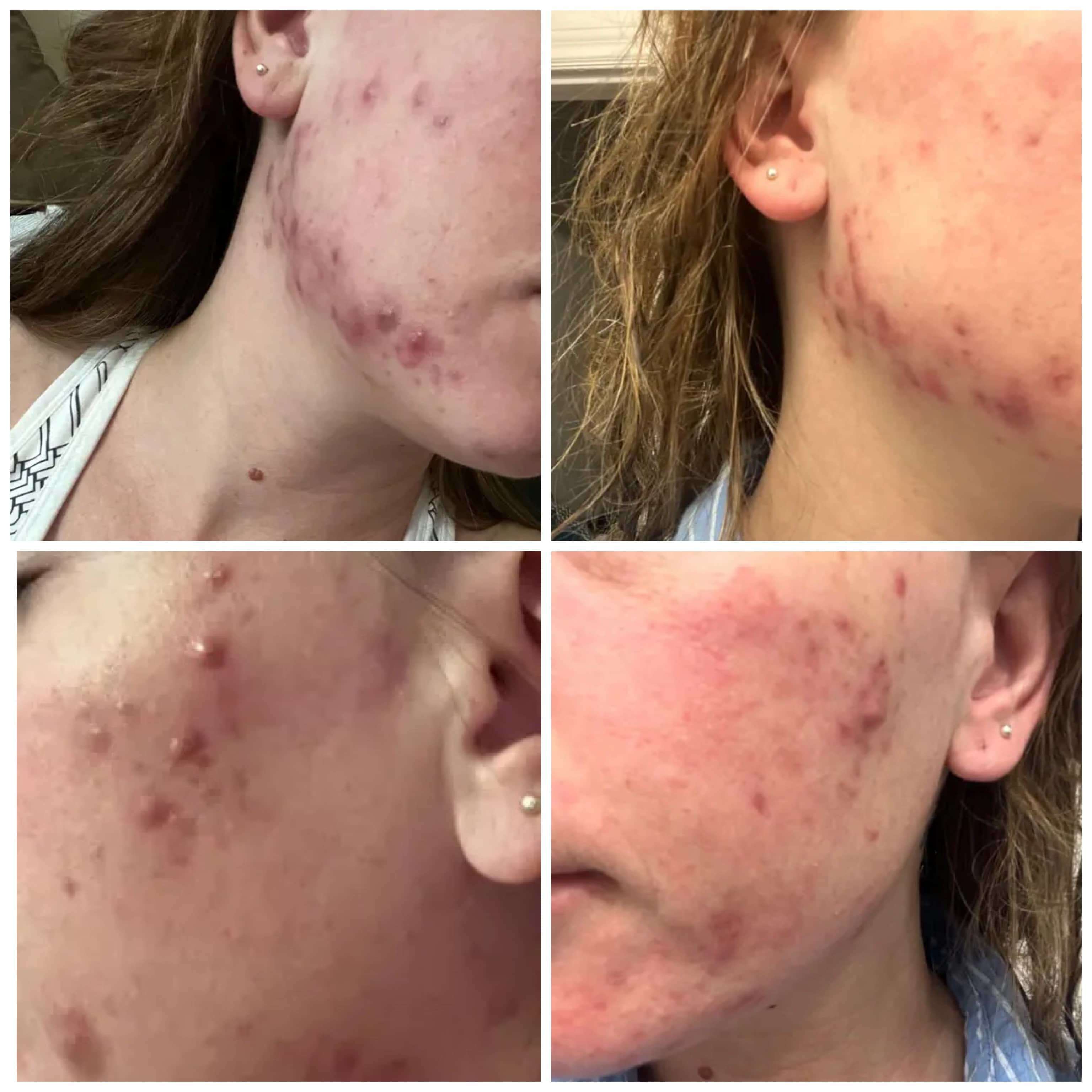 Balanc Pregnancy Acne Toner