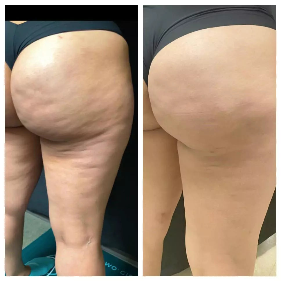 Cheek Chic Cellulite Gel