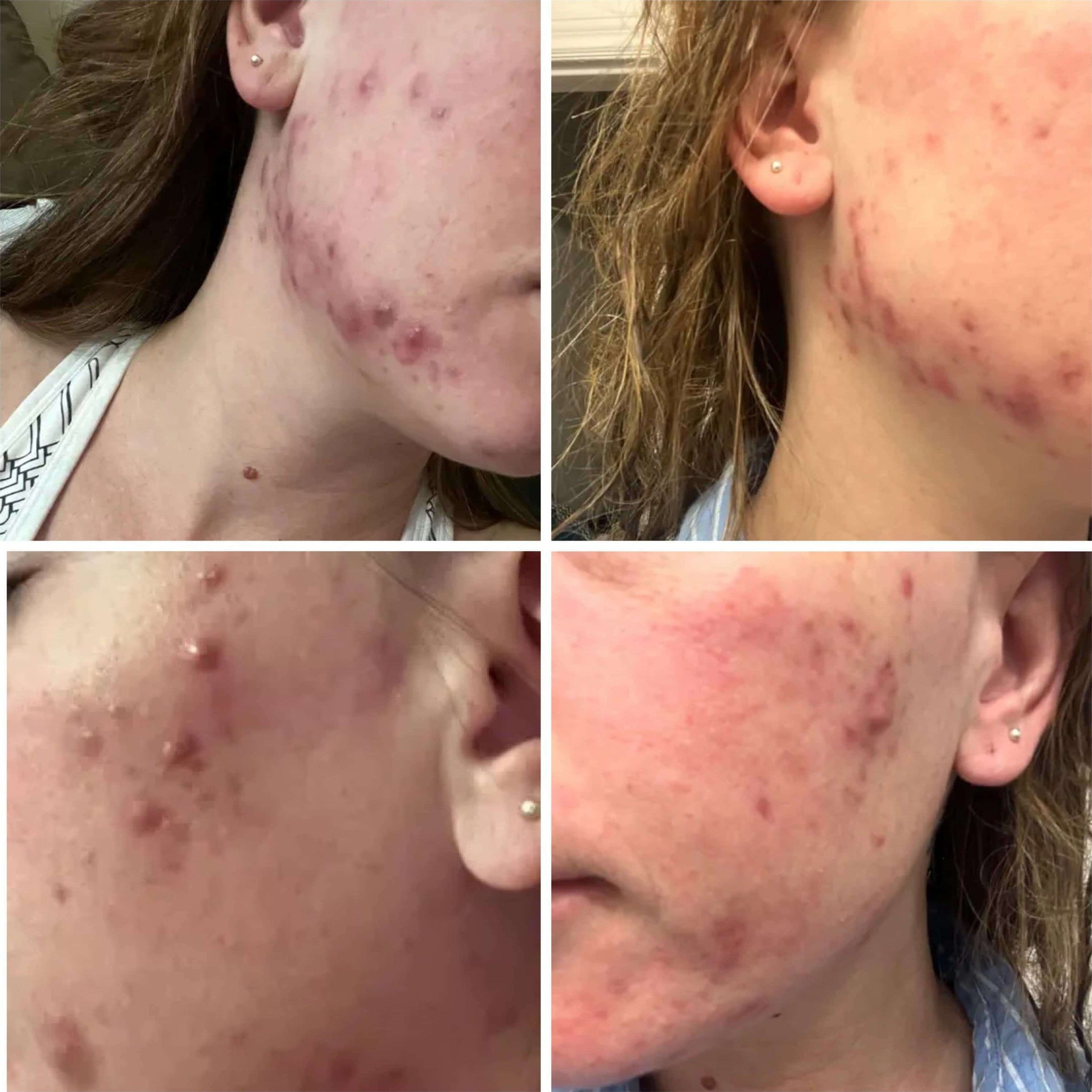 Pregnancy Acne Treatment Kit
