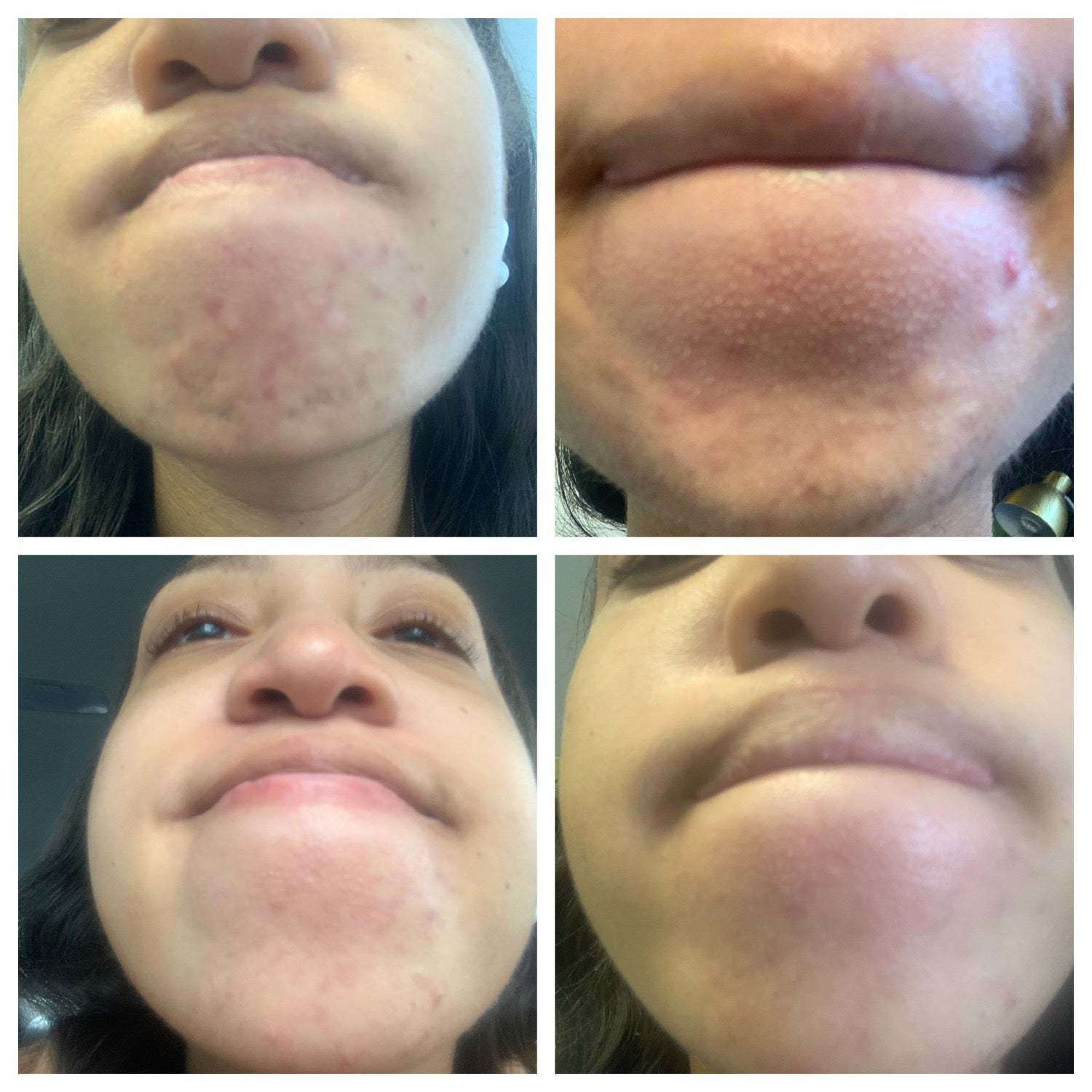 Balanc Pregnancy Acne Toner